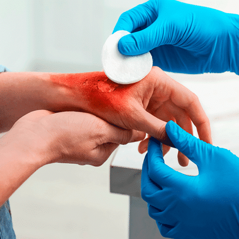 Atención de urgencias a quemados